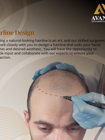 Hairline design is an art. Our skilled surgeons collaborate with you, taking your input to design a hairline that matches your desired aesthetic and facial features for full satisfaction.