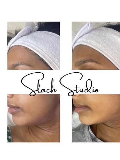 A great example of how the treatment evens out skin tone and texture, reducing patchiness for a clear, healthy glow.