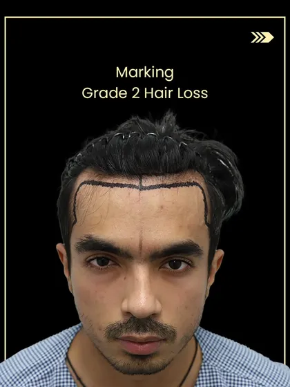 This is Gaurav during the hairline design phase, where we marked the treatment area for his Grade 2 hair loss.