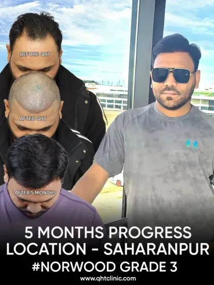 A 5-month transformation for a Grade 3 hair loss patient from Saharanpur. We used 3200 grafts to redefine his frontal zone and hairline.