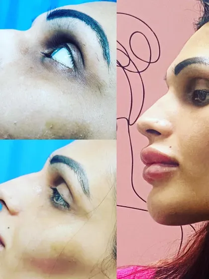 Non-surgical facial contouring allows for remarkable enhancements without any incisions. Here, I used dermal fillers to augment the lips, refine the nose bridge, and strengthen the chin and jawline. This kind of profile balancing creates harmony across all facial features.