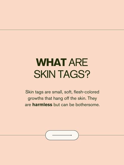 What are skin tags? They are small, soft, flesh-colored growths that hang off the skin. While harmless, they can be bothersome, and I can remove them safely in the clinic.