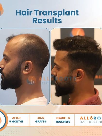 This 9-month result for a Grade 6 baldness case, achieved with 3875 grafts, is a testament to what is possible even in advanced stages of hair loss. The transformation is comprehensive and natural.