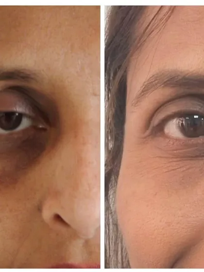 This before and after demonstrates our approach to treating under-eye pigmentation and volume loss. By addressing the specific cause, we can achieve a brighter, more rested appearance.