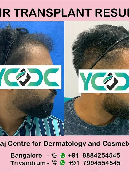 A profile view showing the restored hairline. The patient is holding back the new hair, demonstrating its thickness and natural placement.