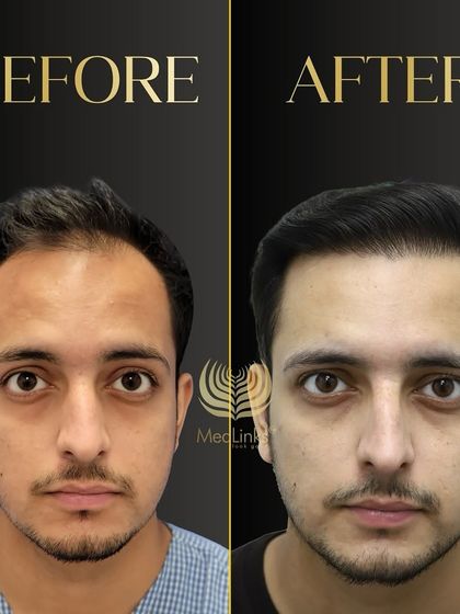A powerful before and after transformation. We restored this patient's hair, giving him a fuller, more youthful look.