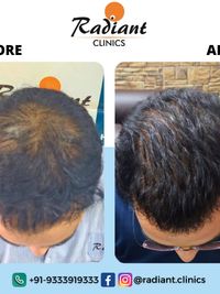 Non-Surgical Hair Restoration