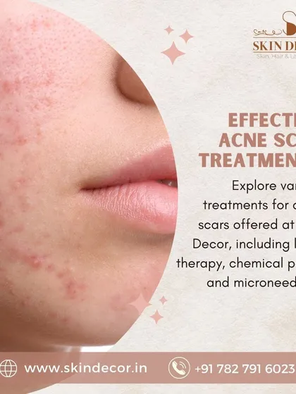 Don't let acne scars affect your confidence. I offer a range of effective treatments tailored to your specific needs, including advanced laser therapy, customized chemical peels, and precision microneedling to promote smoother, clearer skin. We can discuss which option is best for you during our consultation.