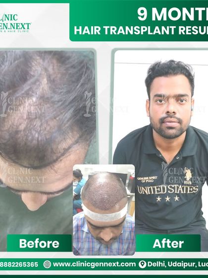 This patient achieved a full, natural-looking head of hair just 9 months after his procedure with me. We focused on restoring density to the crown and frontal area, giving him back his confidence.