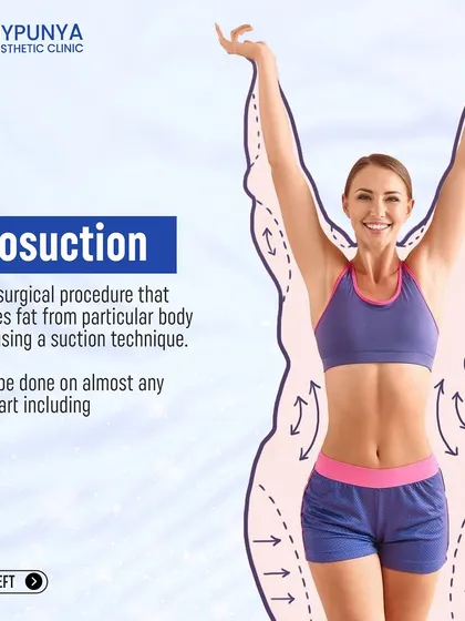 Liposuction is a surgical procedure that removes fat from particular body parts using a suction technique. It can be done on almost any body part.