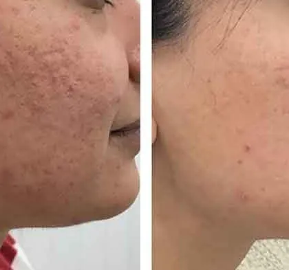A powerful example of how a tailored acne scar treatment plan can transform the skin. I focus on addressing different types of scars, from rolling to boxcar, for a comprehensive and satisfying result.