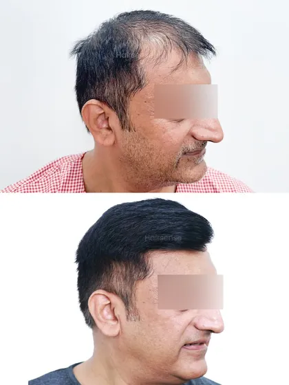 Another angle showcasing the complete change in the patient's hair profile, from thinning and receding to thick and well-defined.
