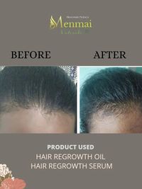 Hair Fall & Regrowth Treatment