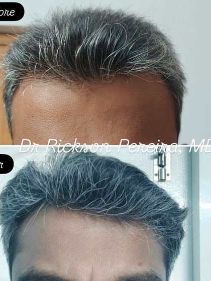 The frontal hairline shows noticeable improvement in density and definition. My treatment plans are designed to tackle hair loss from multiple angles, but the patient's commitment is just as crucial for success.