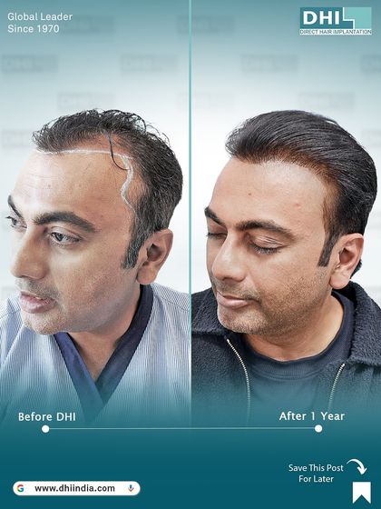 This alternate side-profile view demonstrates the seamless flow and density from the front to the back. After one year, the 6,054 implanted hairs have created a full and natural look.