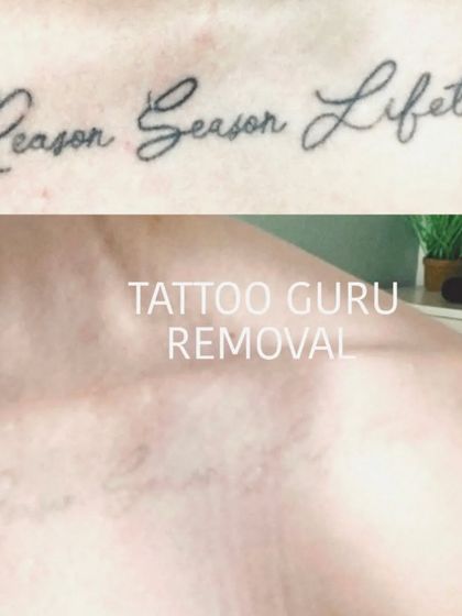 This client wanted to remove a quote from their collarbone. The after photo shows the skin almost completely clear, with only very faint traces of the old ink remaining.