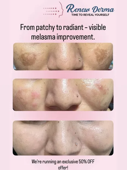 Melasma can be stubborn, but with the right approach, we see incredible improvements. This before-and-after shows a visible reduction in patchy pigmentation after a personalized treatment plan. Getting an even, radiant skin tone is absolutely possible.