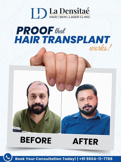 This transformation speaks for itself. From thinning hair to a thick, natural-looking result, this journey is about more than just appearance; it's about regaining the confidence that hair loss can take away.