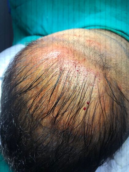 We offer both shaved and unshaved hair transplant methods. This image shows an unshaved FUE procedure, where we work around existing hair, making the process more discreet for clients who prefer it.