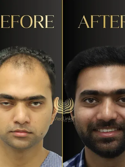 This before and after comparison shows a dramatic improvement in hair density and hairline. The patient looks younger and more confident.