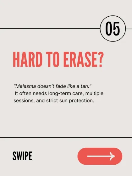 Melasma doesn't fade like a tan. It is a persistent condition that often requires long-term care, multiple treatment sessions, and strict, consistent sun protection to manage effectively.