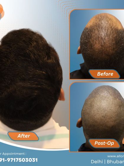 Another complete journey from before to post-op to a fantastic final result. This visual story demonstrates the effectiveness and predictability of my FUE hair transplant technique.
