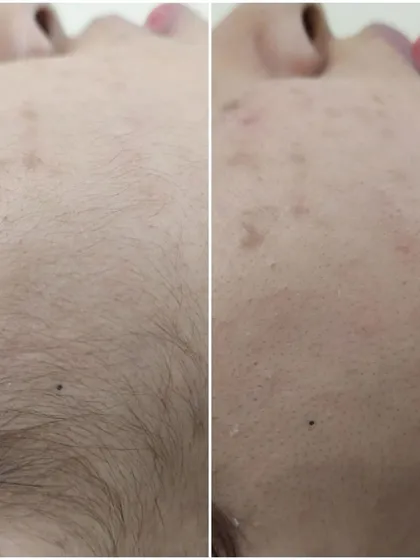 This before and after comparison shows the immediate effect of a dermaplaning session on the cheek and jawline. Notice how the removal of peach fuzz and the top layer of skin reveals a clearer and more radiant surface.