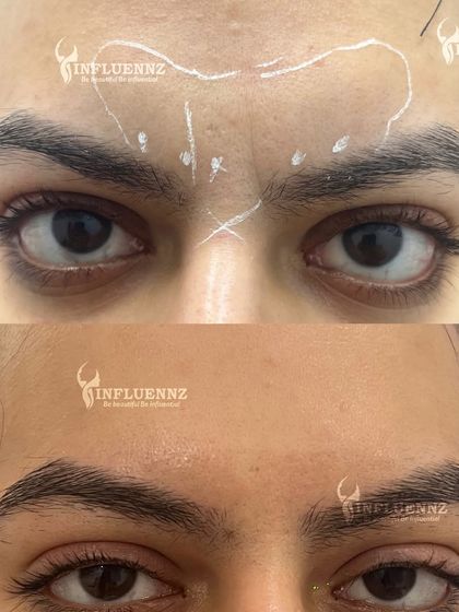 A fantastic before and after of Botox for frown lines. You can see the dramatic smoothing effect between the eyebrows, which softens the entire face.