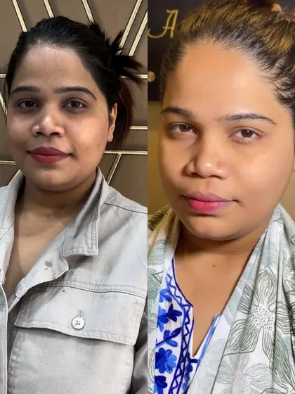 A clear example of the brightening results from my Korean Whitening Treatment. This before and after shot shows a significant reduction in dullness and a much more radiant and even skin tone.