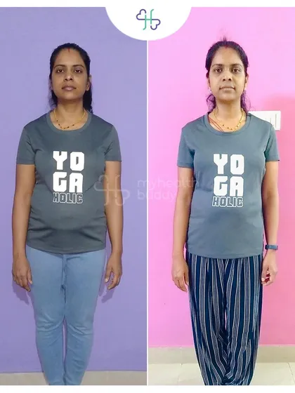 This client learned about Diastasis Recti after her pregnancy and decided to take action. In 12 weeks, she lost 6 kgs and significantly improved her core strength by focusing on portion control and targeted exercises.