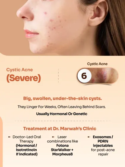 Cystic Acne is a severe form characterized by large, swollen, under-the-skin cysts that are often hormonal or genetic. Our comprehensive treatment involves doctor-led oral therapy, advanced laser combinations like Fotona StarWalker, and PDRN injectables for post-acne repair.