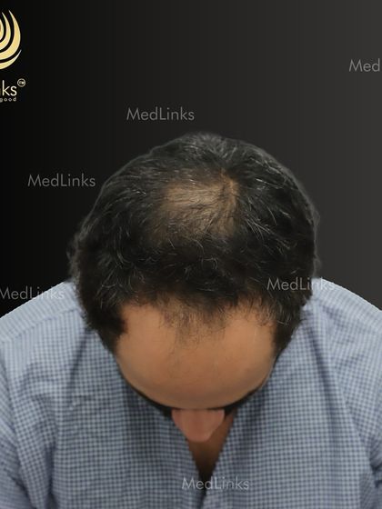 A top-down view of the patient's hair loss before the transplant.