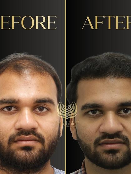 This before and after comparison shows a dramatic improvement in hair density and hairline. The patient looks younger and more confident.