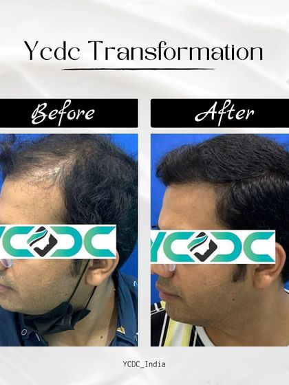 A clear transformation showing the side profile of a patient who has regained significant hair density and a natural-looking hairline.