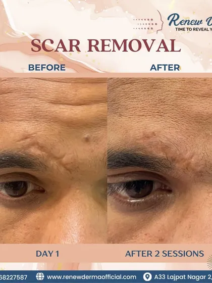 This client saw a noticeable improvement in his forehead scar after just two sessions. We create customized plans to effectively treat and reduce the visibility of old scars.
