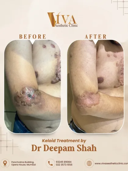 This was a challenging case of extensive and hard keloids on the chest and arm. I created a multi-step treatment plan using intralesional injections and fractional CO2 laser to break down the tough scar tissue. The 'after' photo shows a significant flattening and reduction, making the skin much smoother and more comfortable for the patient.