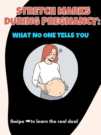 This is what no one tells you about stretch marks during pregnancy. Let's learn the real deal about why they happen.