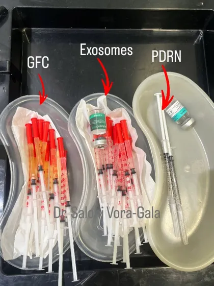 This is what science-backed hair restoration looks like. In my clinic, we use advanced regenerative treatments like GFC (Growth Factor Concentrate), Exosomes, and PDRN. These are not magic potions; they are powerful biological tools that signal your own body to heal, repair, and stimulate hair follicles at a cellular level.
