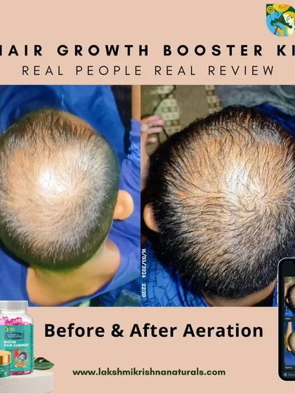 This is the kind of result that makes our work meaningful. This before and after photo shows the progress a customer made using our Hair Growth Booster Kit. You can see a visible increase in hair density and coverage over the bald patch.