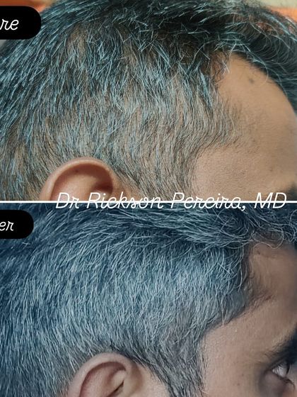 This image focuses on the temple area, another common site for male pattern baldness. The after photo shows significant regrowth, proving that a consistent, scientific approach yields tangible results over time.