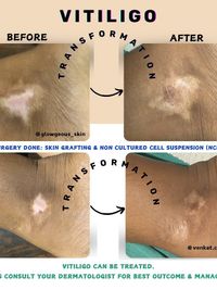 Pigmentation Disorders & Skin Tone Correction