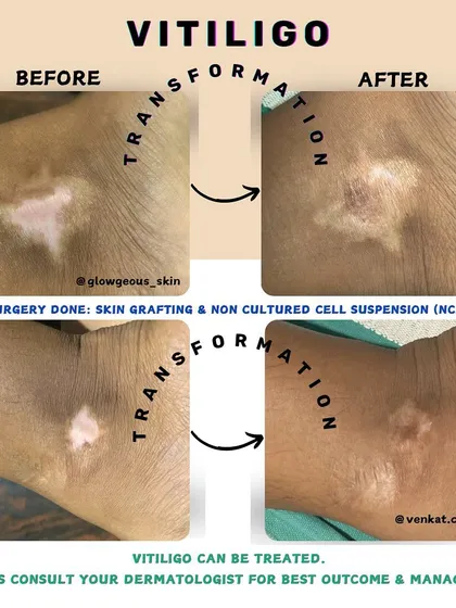 This is the power of a scientifically-backed treatment plan. For this patient with stable vitiligo, we used a combination of skin grafting and non-cultured cell suspension to restore pigmentation. This isn't a quick fix; it's a life-changing surgical procedure that offers real hope and lasting results.