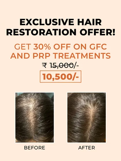 A widening hair part is a common sign of hair thinning. This before and after photo demonstrates how our targeted GFC and PRP treatments can effectively increase hair density and improve scalp coverage.