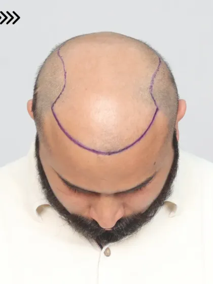 The before, marking, and after stages of a hair transplant, showing the clear plan and the resulting growth.