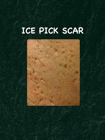 Ice pick scars are deep, narrow scars that can be challenging to treat. I use targeted methods like TCA CROSS peels to address this specific type of scarring.