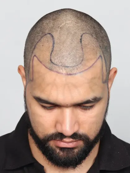 A 10-month natural transformation for a Grade 3 baldness case using 3700 grafts. We recreated the hairline, temples, and frontal zone.