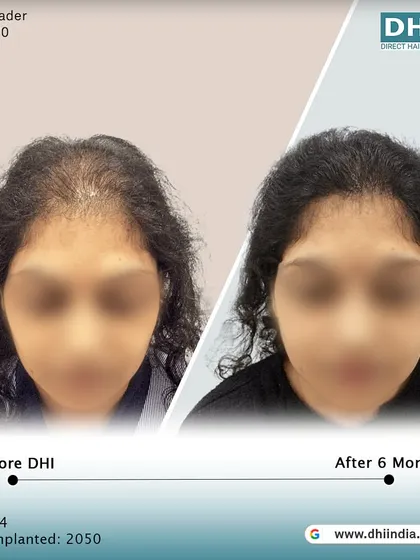 A frontal before and after of the 34-year-old female client. The restored hairline and fuller look have given her a renewed sense of confidence just 6 months after her hair transplant.