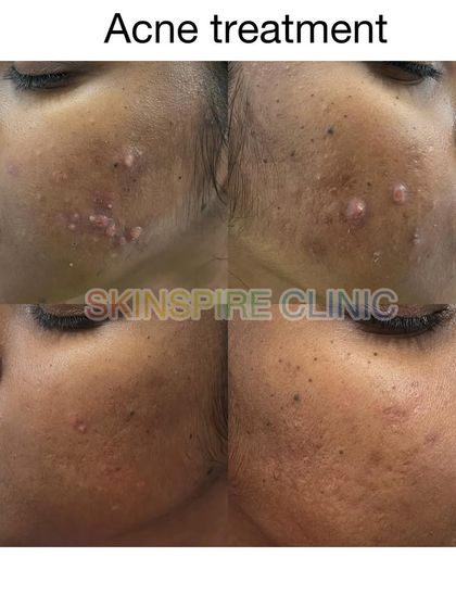 Another example of our customized acne treatment, showing a visible reduction in pustules and inflammation. We focus on a two-step process: first calming the skin, then treating the residual marks.