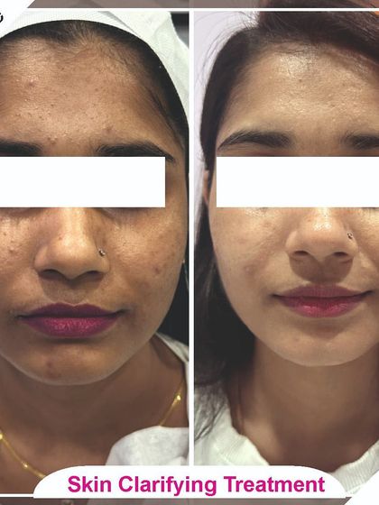 Our skin clarifying treatment effectively reduced pigmentation and improved this client's overall skin texture, leaving her with a healthy, radiant glow.