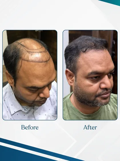 A receding hairline and thinning on the crown can be completely reversed. This before and after photo shows a significant increase in density and a natural-looking result after a successful hair restoration procedure at our clinic.
